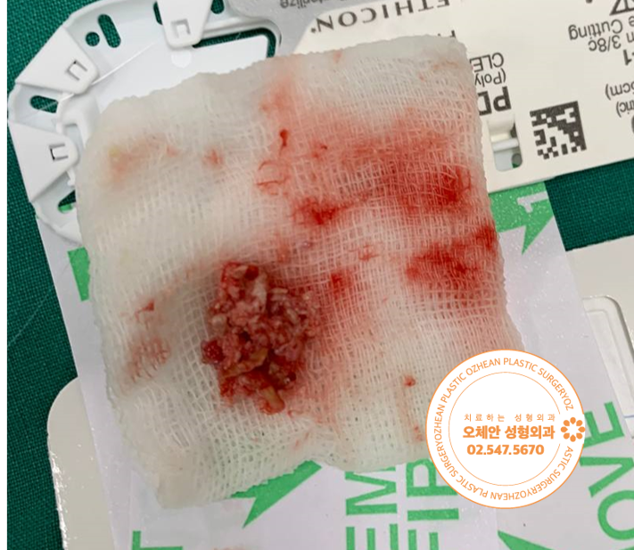 제거된 표피낭종 병변 사진