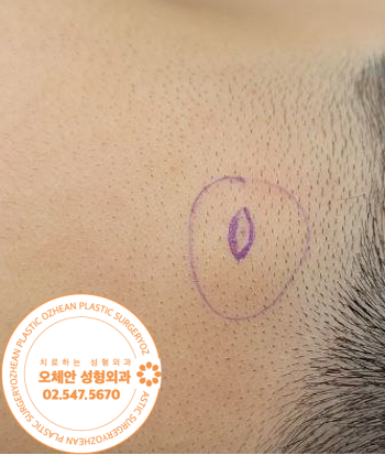 수술 전 뒷목에 위치한 표피낭종 병변 사진