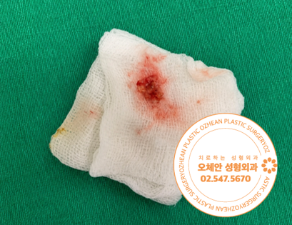 제거된 왼쪽 귓볼 표피낭종 병변 사진
