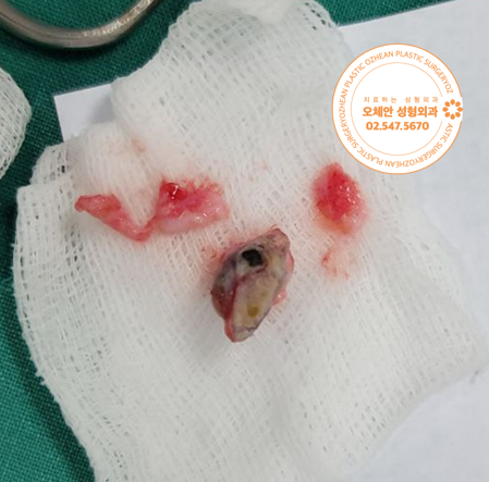 제거된 엉덩이 표피낭종 병변 사진