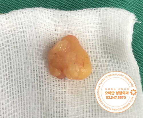 팔에서 피막까지 깔끔하게 제거된 지방종 덩어리 사진