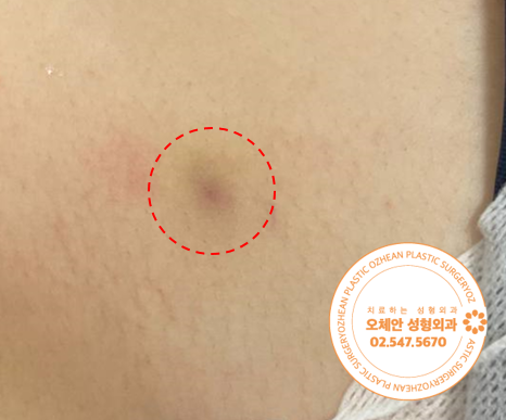 수술 전 쇄골 1cm 멍울 사진