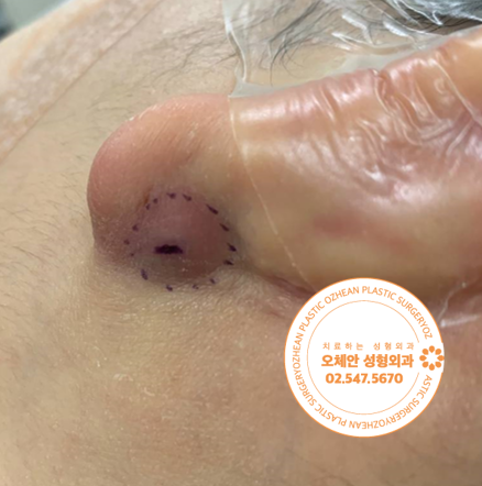 수술 전 왼쪽 귓볼 표피낭종 사진