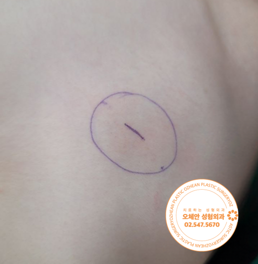 f085a43db38fa2d239e42b554f3c11d1.png 수술 전 왼쪽 어깨에 볼록하게 튀어나온 지방종 병변 사진