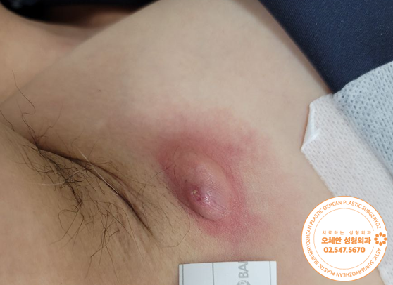 겨드랑이 표피낭종