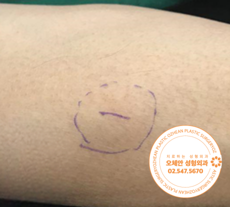 수술 전 팔에 볼록하게 위치한 지방종 사진