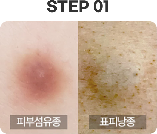 피부섬유종 DERMATOFIBROMA 이미지