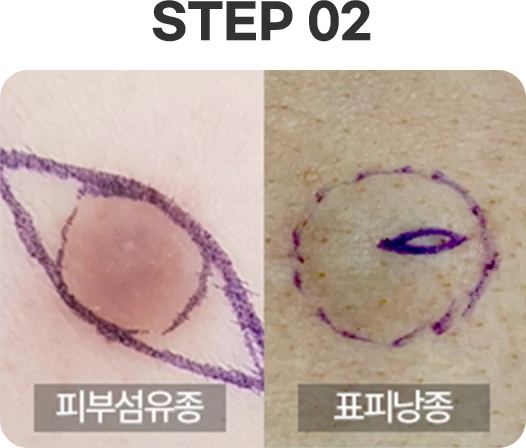 피부섬유종 DERMATOFIBROMA 이미지