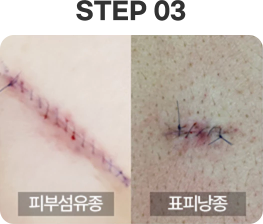 피부섬유종 DERMATOFIBROMA 이미지