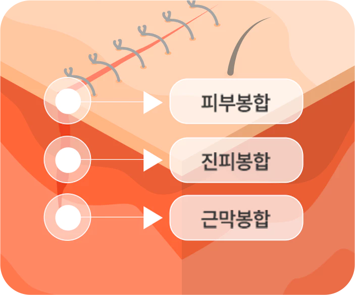 모낭손상최소화 이미지