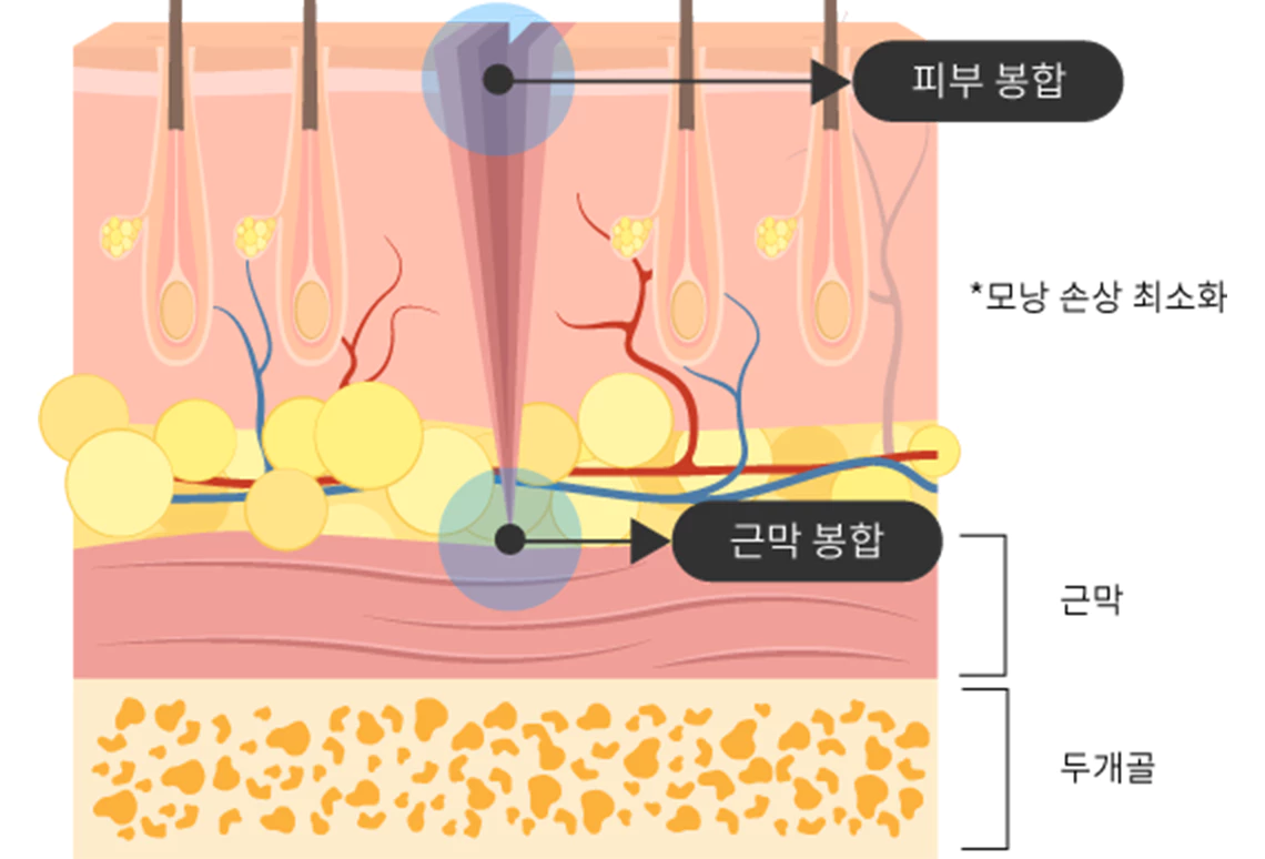 모낭손상최소화 이미지