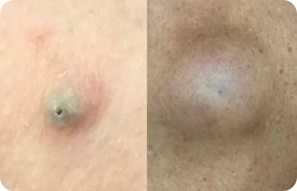 표피낭종 EPIDERMAL CYST 이미지