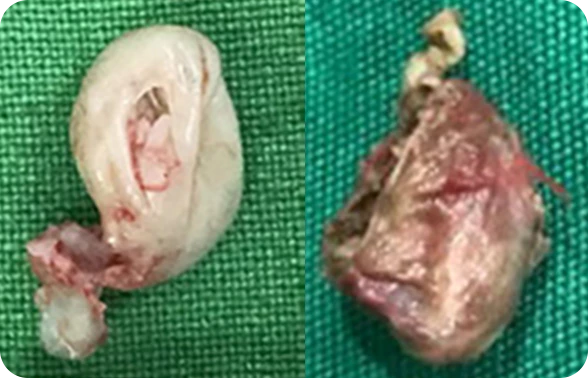 표피낭종 EPIDERMAL CYST 이미지