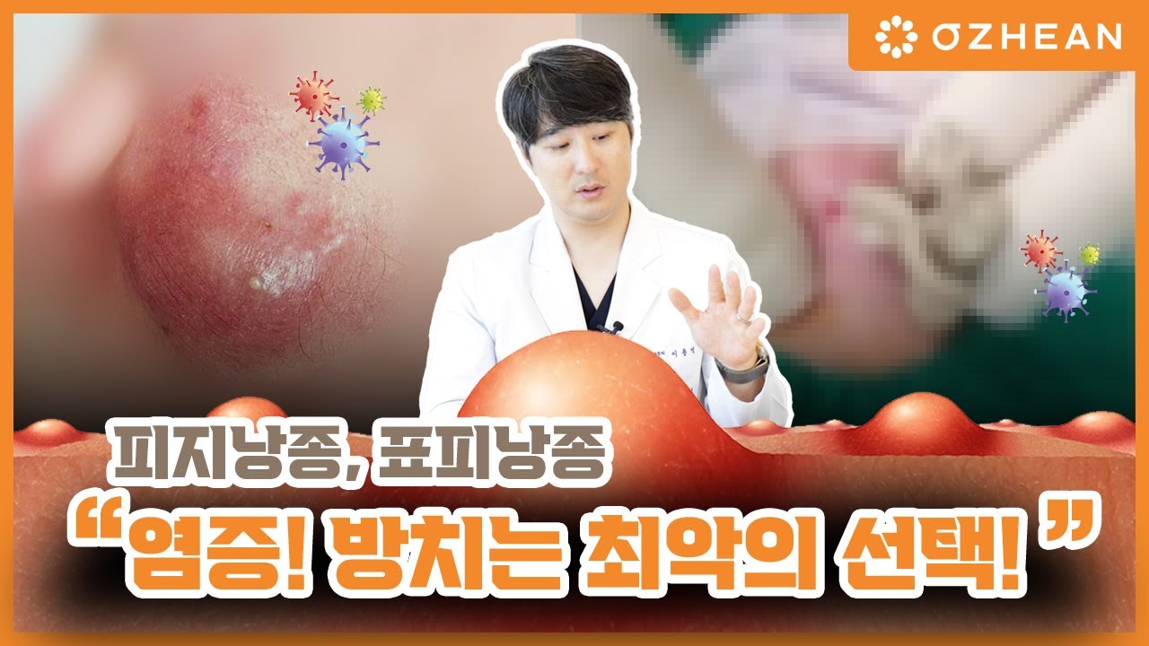 오체안TV | 피지낭종, 표피낭종 방치하면 이렇게 돼요! 성형외과 의사가 알려주는 대처법, 꼭 알아가세요