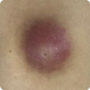 피지낭종/표피낭종 초반 염증기, 중반 고름기, 후반 만성 염증기 이미지