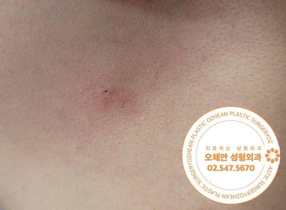 목에 종기 까만 점같은게 있다면? 표피...