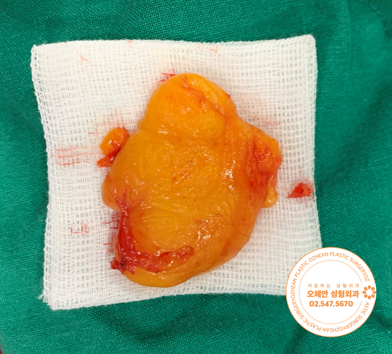 지방종 제거 안 하면 어떻게 될까요?...