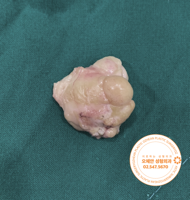 옆구리에 혹이 만져지면서 통증이 있다면...