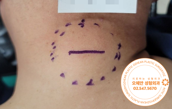 목뒤 멍울 병원 지방종 수술 경험 풍부...