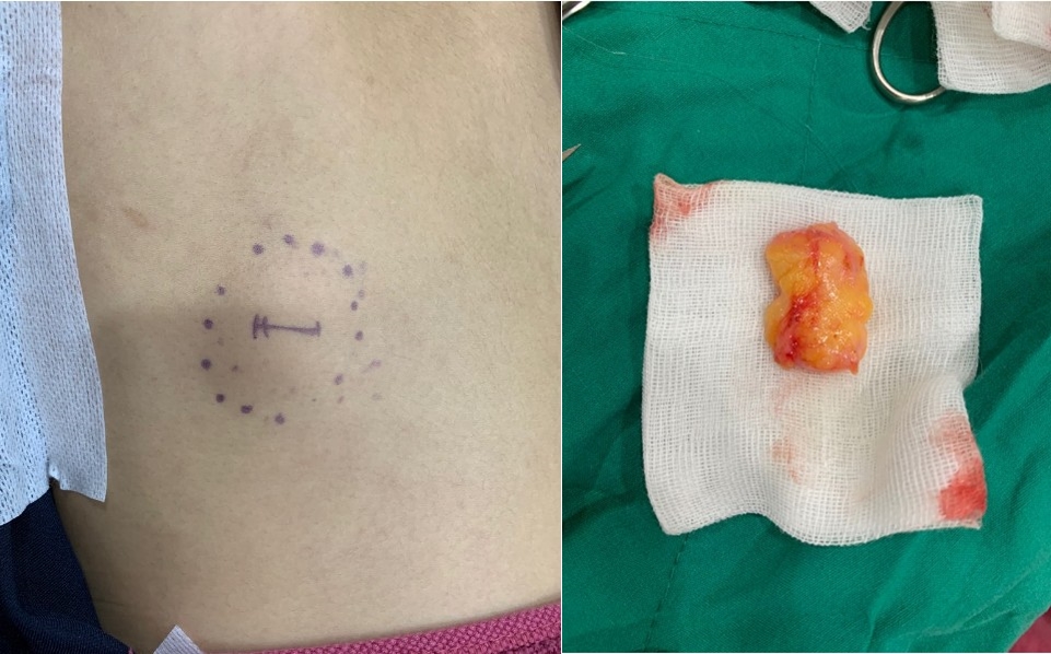 The S-Plus lift: a short-scar, long-flap rhytidectomy. - Abstract - Europe  PMC