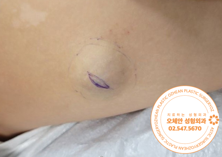 다리 종기 악취나는 이물질이 나온다면 ...