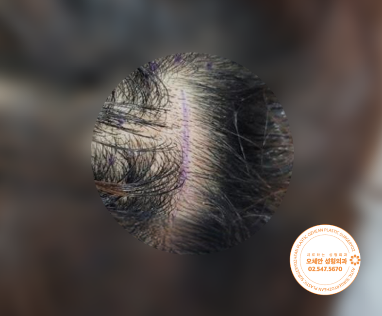 뒷머리 혹 지방종, 삭발 없이 제거할 ...