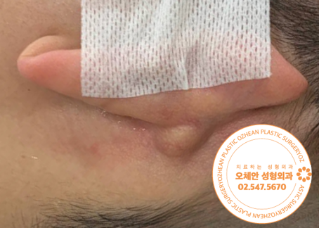 귀뒤 멍울 방치하지 말고 수술로 제거해...