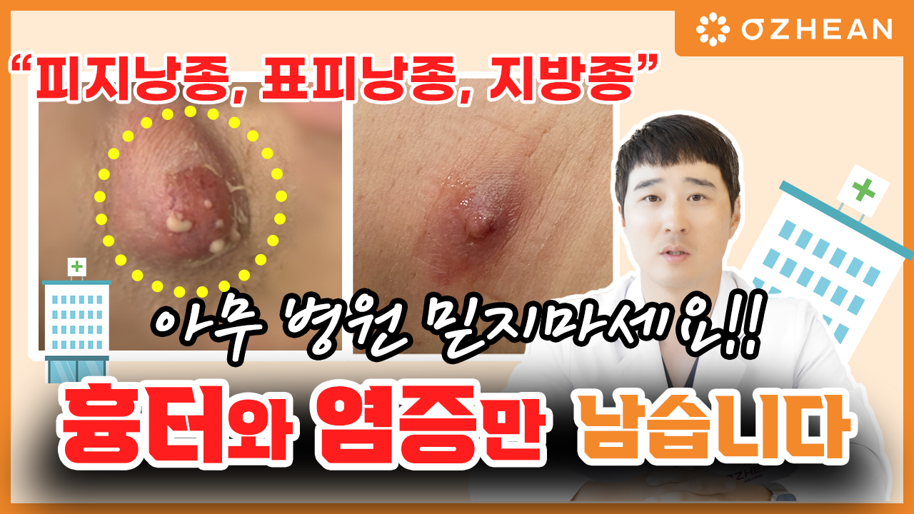※경고※  피지낭종, 지방종! 잘못된 병원 선택은 흉터와 염증만 남겨요!! 오체안 뉴스 썸네일