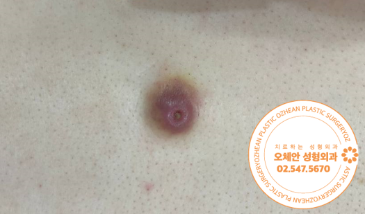 붉어지고 아파진 혹 염증성 표피낭종 제...