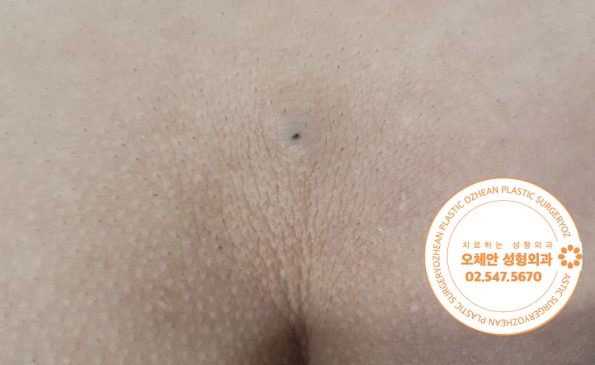 엉덩이 표피낭종 통증 반복된다면