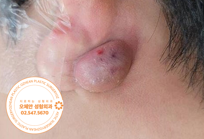 귓볼 멍울 홍반과 동통이 있다면 즉시 치료 해야