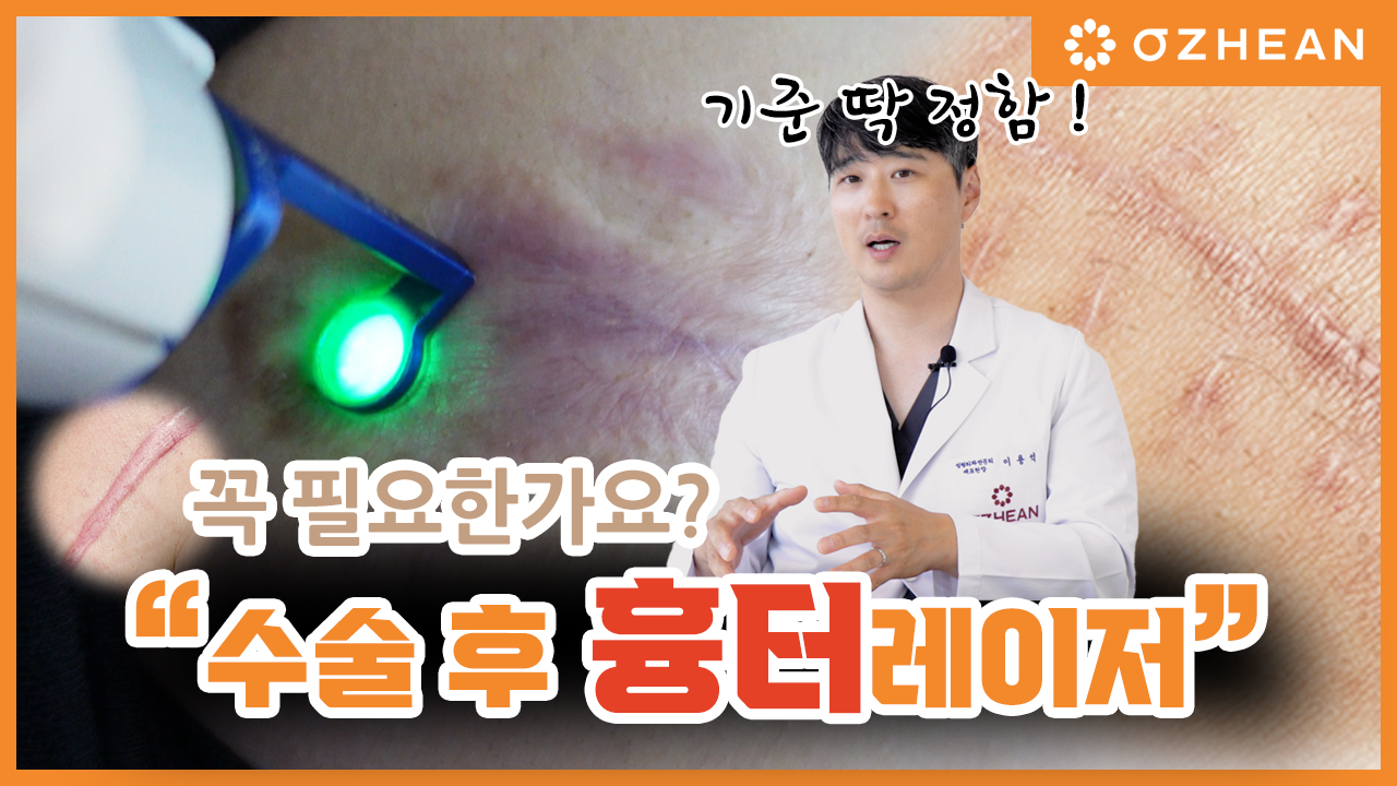 수술흉터, 흉터레이저 꼭 필요할까? 흉터치료 골든타임을 지켜라! 오체안 뉴스 썸네일