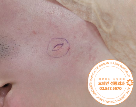 귀 밑 모기질종 특징과 치료 방법 ...