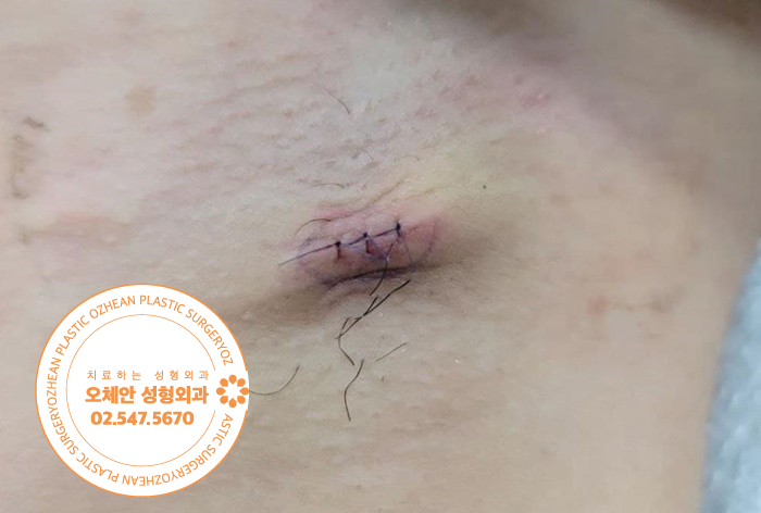 남자 겨드랑이 혹 재발률 낮추려면 