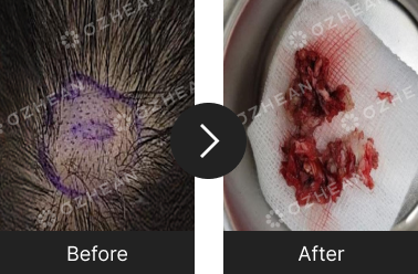 정수리 혹 제거 수술 오체안 전후사진 썸네일