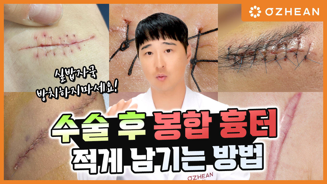 수술 후 봉합 흉터 적게 남기는 방법 (실밥 자국, 켈로이드 흉터) 오체안 뉴스 썸네일