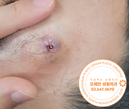 눈썹에 발생한 염증성 낭종 제거 수술 ...