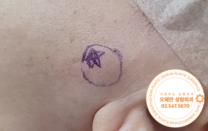 귀옆 혹 표피낭종 제거 수술 전 어떤 ...