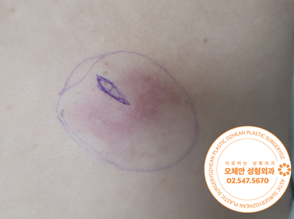 날개뼈 표피낭종 염증 발생한 경우 제거 방법