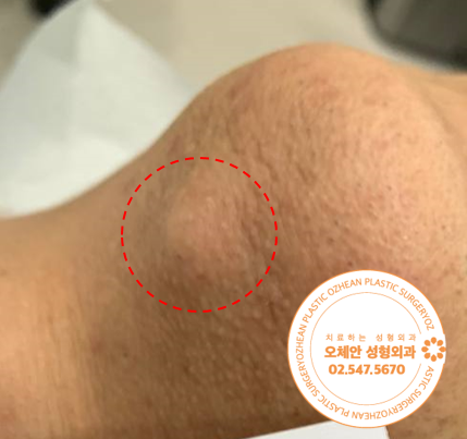 턱 아래 피지낭종, 짜서 하얗게 나왔다면?