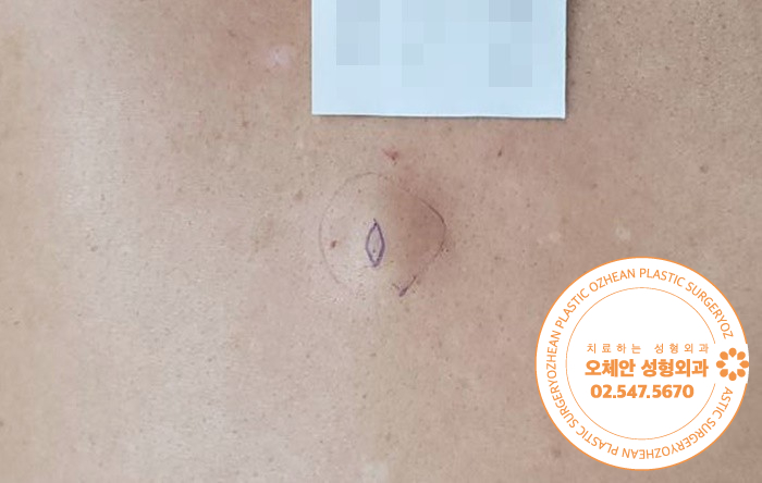 피부 종기 유형과 원인 및 치료 방법...