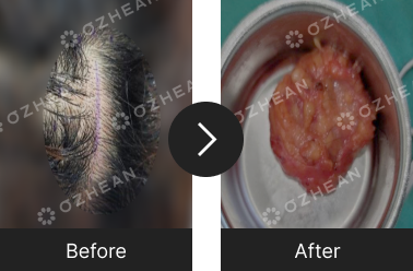 뒷머리 혹 지방종 제거 수술 오체안 전후사진 썸네일