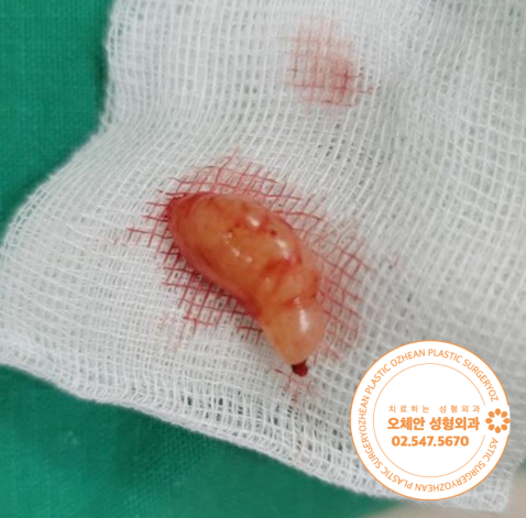 헤어라인에 생긴 지방종, 흉터 줄이면서...