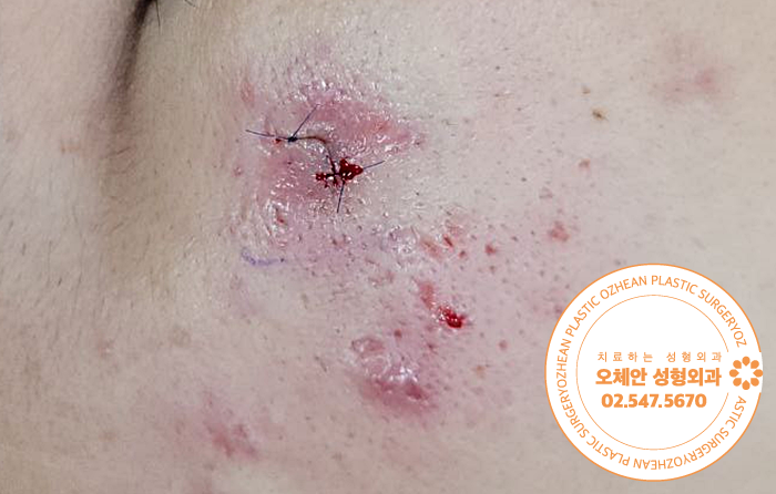표피낭종병원 광대 부위 멍울이 터졌다면...