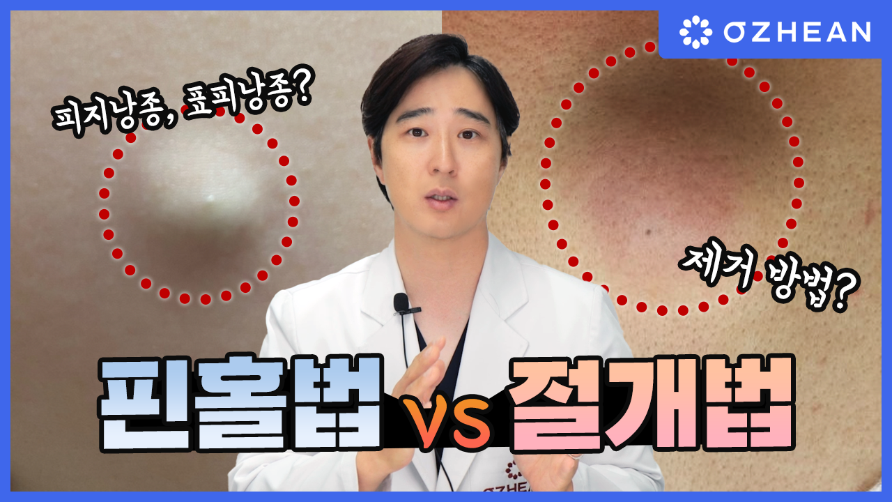 핀홀법 vs 절개법: 당신에게 맞는 피지낭종, 표피낭종 제거 방법은? 오체안 뉴스 썸네일