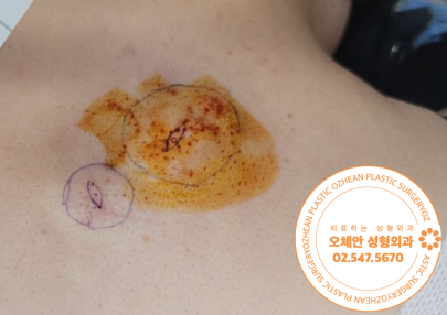 뒷목 낭종 표피낭종 수술로 낭종주머니까...