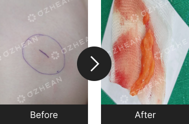 왼쪽 어깨 지방종 제거 수술 오체안 전후사진 썸네일