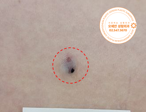엉덩이 표피낭종 제거, 1cm라도 몇 년째 남아있다면