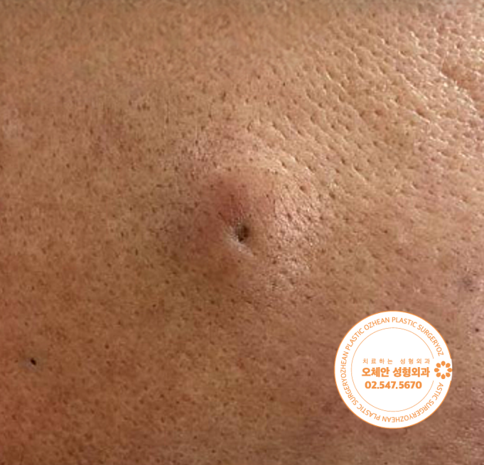 얼굴, 뺨 볼에 멍울이 만져진다면 놓치...