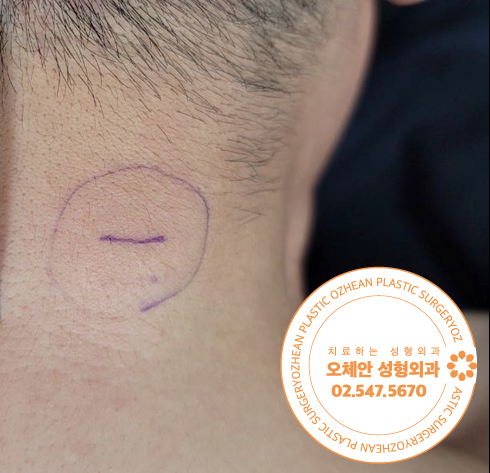 목덜미 혹 통증없는 덩어리가 만져진다면 지방종 진단 받아보세요
